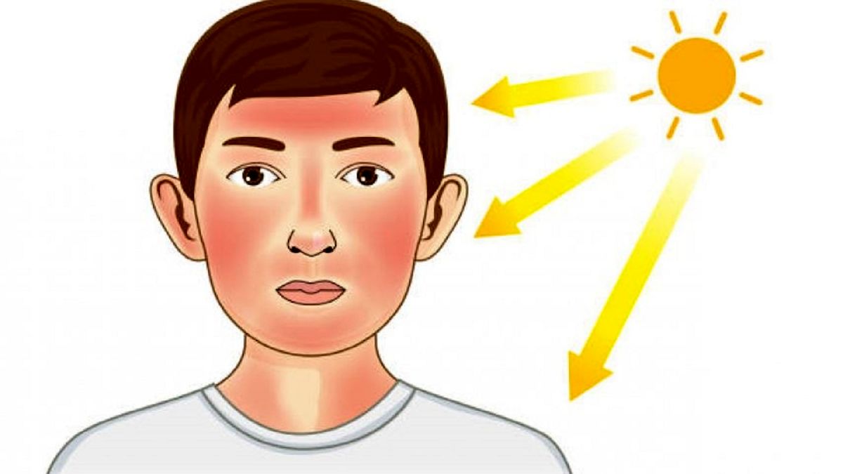 کارهایی که پس از ابتلا به آفتاب سوختگی نباید انجام داد