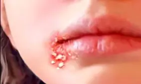 زرد زخم یا ایمپتیگو چیست؟