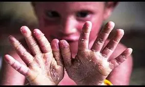 صدای کودکان پروانه‌ای را بشنوید/بیماری «ای بی» جزو بیماری‌های خاص شناخته شود+ویدئو