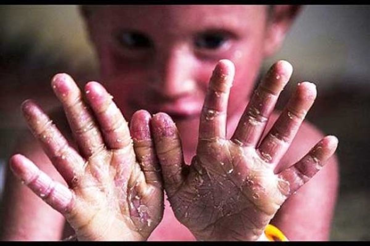 صدای کودکان پروانهای را بشنوید/بیماری «ای بی» جزو بیماریهای خاص شناخته شود+ویدئو