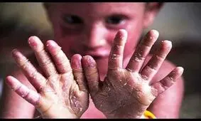 صدای کودکان پروانه‌ای را بشنوید/بیماری «ای بی» جزو بیماری‌های خاص شناخته شود+ویدئو