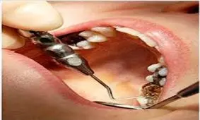 ایرانیان در 50 سالگی چند دندان ندارند؟