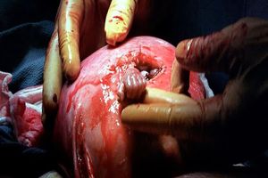 جنینی که پیش از تولد دست جراحش را فشرد/عکس