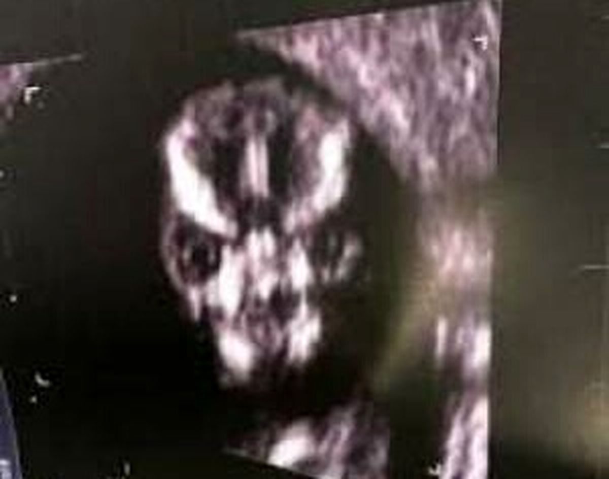 وحشت مادر از عکس سونوگرافی جنین داخل شکمش