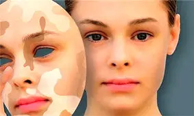 بیماری برص، لک و پیسی و درمان آن