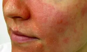 چطور عارضه اگزمای صورت را شناسایی کنیم؟/ اینفوگرافیک