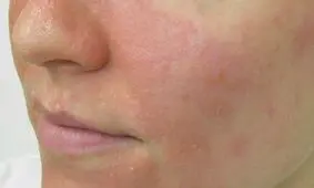 چطور عارضه اگزمای صورت را شناسایی کنیم؟/ اینفوگرافیک