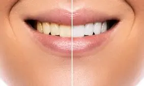 تاثیر مخرب محصولات سفید کننده بر دندان‌ ها