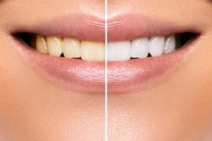 تاثیر مخرب محصولات سفید کننده بر دندان‌ ها