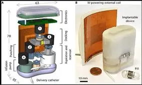 پمپ انسولینی که درون بدن قرار می‌گیرد و با کپسول خوراکی شارژ می‌شود