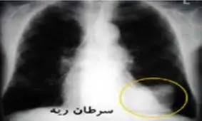 مهمترین نشانه های سرطان ریه را بشناسید/ اینفوگرافی