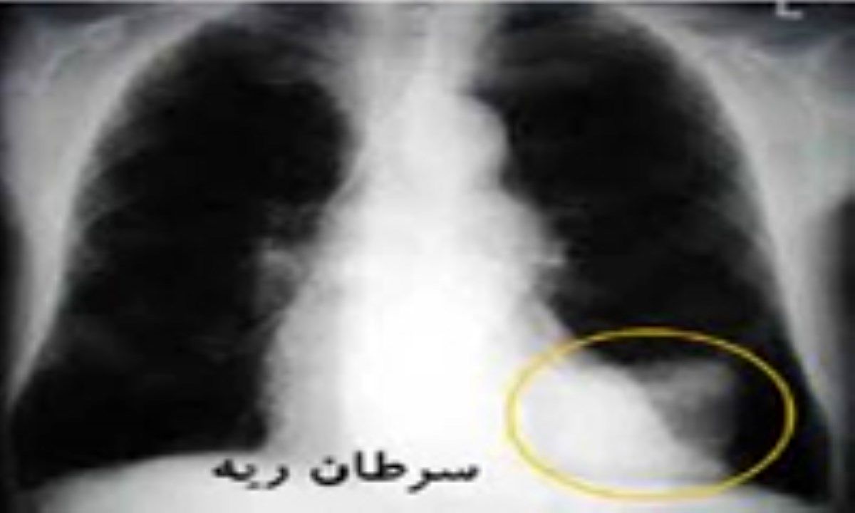 مهمترین نشانه های سرطان ریه را بشناسید/ اینفوگرافی