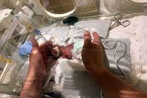 کوچکترین نوزاد جهان از بیمارستان مرخص شد