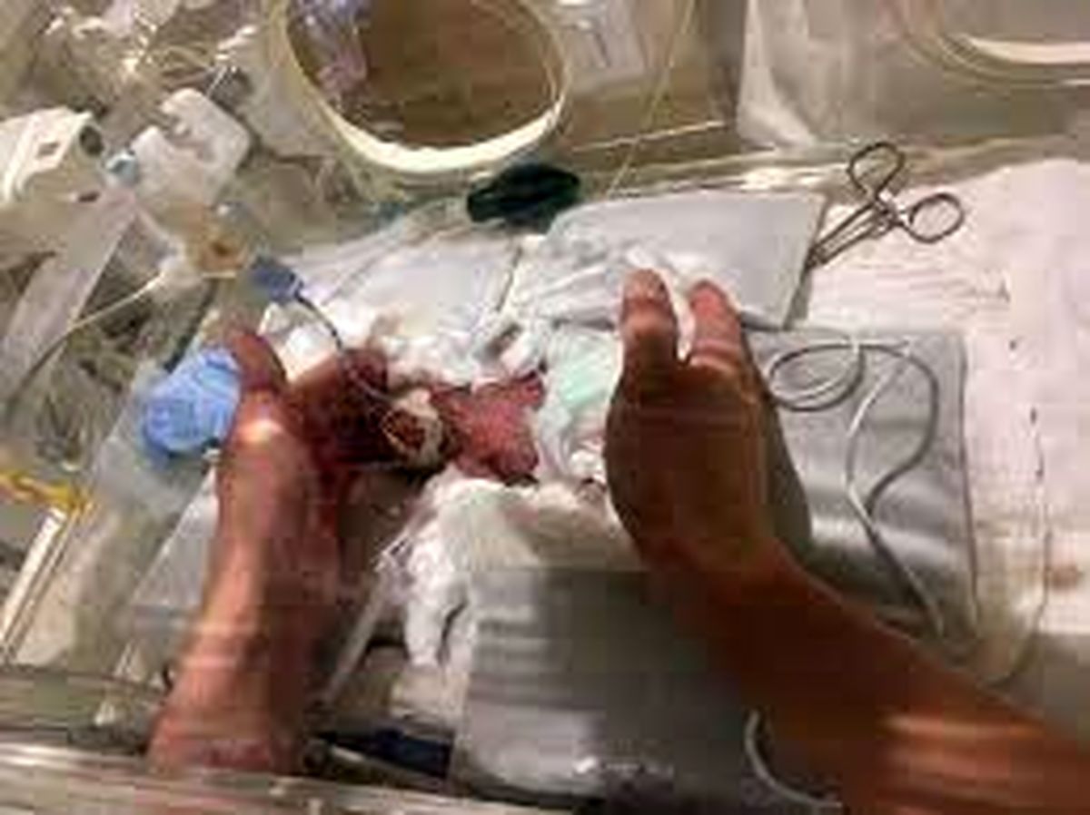 کوچکترین نوزاد جهان از بیمارستان مرخص شد