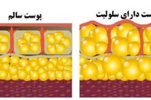 سلولیت را می توانید با ۷ تکنیک ساده در عرض یک ماه از بین ببرید