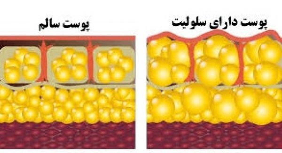 سلولیت را می توانید با ۷ تکنیک ساده در عرض یک ماه از بین ببرید