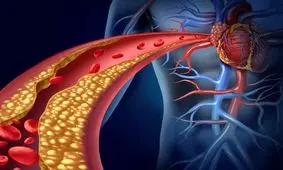 کلسترول چیست؛ هرآنچه باید درباره کلسترول بدانیم