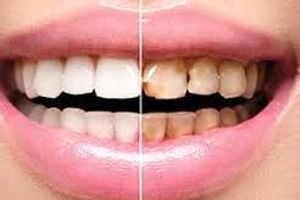 خوردنی هایی که باعث پوسیدن دندانها می شود
