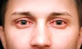 همه چیز درباره قارچ سیاه/ این بیماری یک عفونت قارچی جدی است