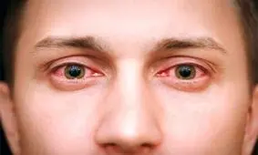 همه چیز درباره قارچ سیاه/ این بیماری یک عفونت قارچی جدی است