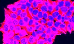 بهبود درمان سرطان لوزالمعده با کمک مدل ۳ بعدی تومور