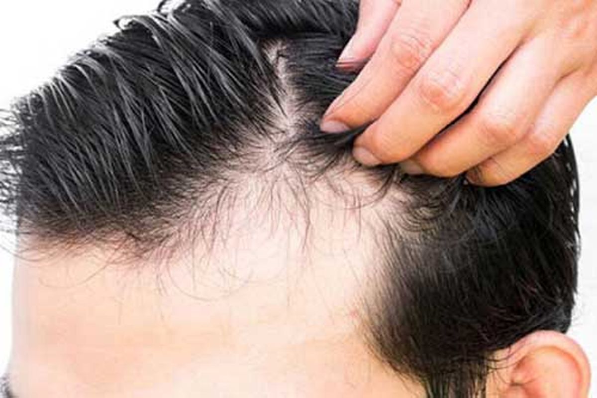 ریزش مو پس از بیماری کرونا درمان می شود؟
