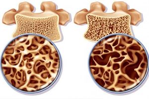 استخوان‌ها به کدام ریزمغذی ها نیاز دارند؟