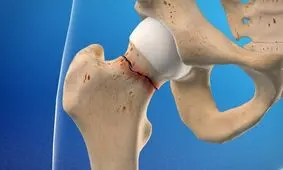 این ماده معدنی خطر شکستگی لگن را به نصف کاهش می‌دهد