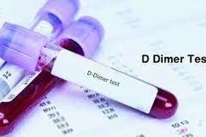 انجام تست دی-دایمر خون برای جلوگیری از آمبولی در مبتلایان به کرونا