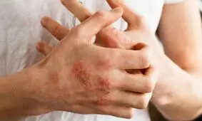 سه روش درمان خانگی اگزما