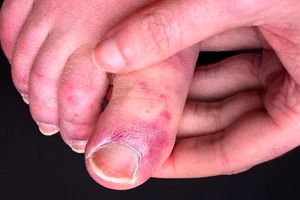 بیماری انگشت پا کوویدی چیست؟