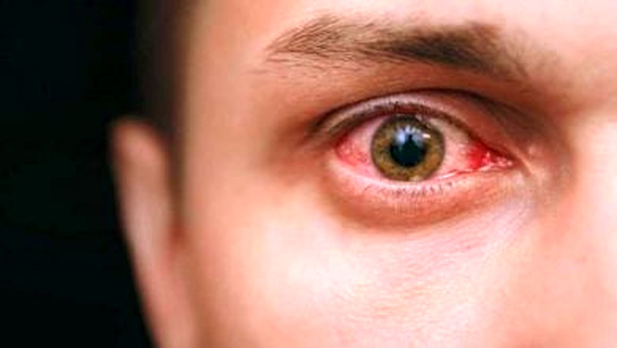 بیماری‌هایی که با معاینه چشم مشخص می‌شوند!/ اینفوگرافیک