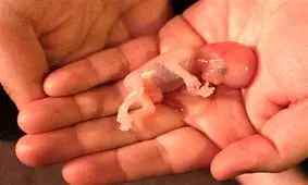 روزانه ۲ هزار سقط جنین در کشور؛ سالانه ۷۰۰ هزار مورد