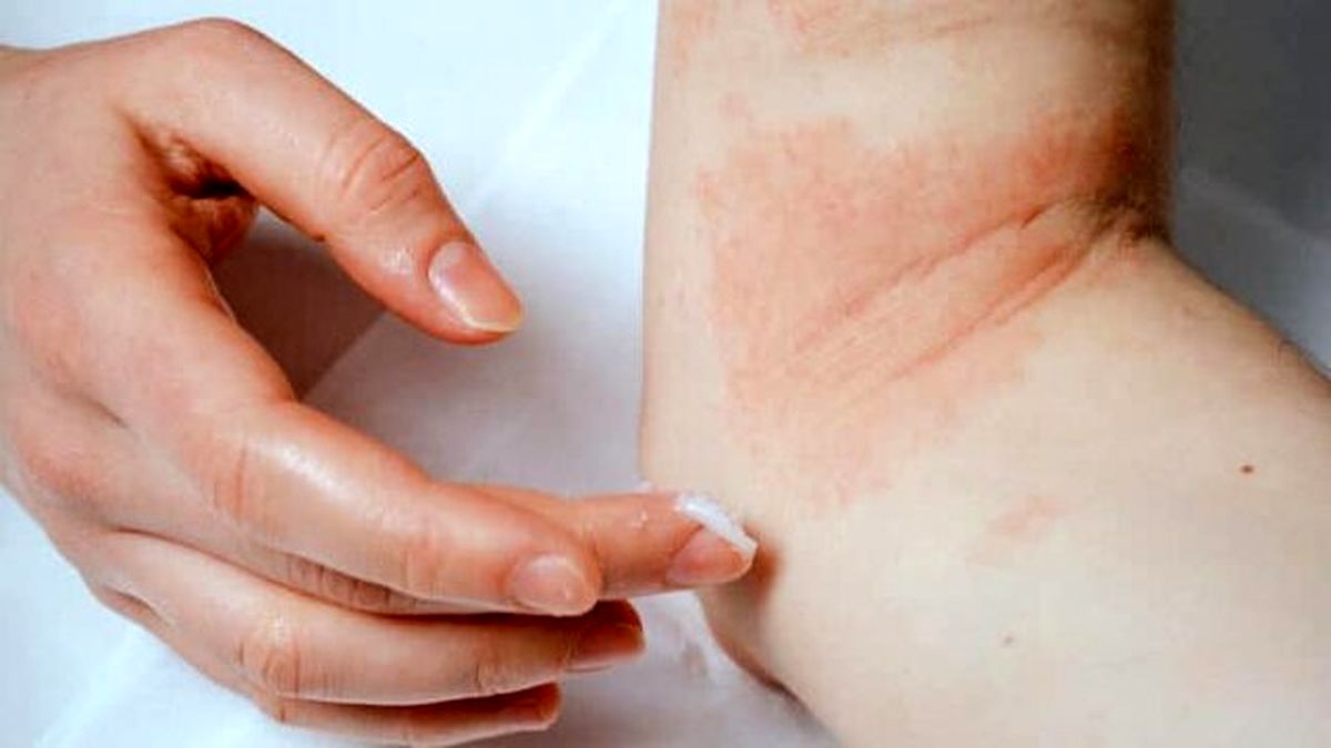 نقش هورمونهای جنسی در ایجاد اگزما