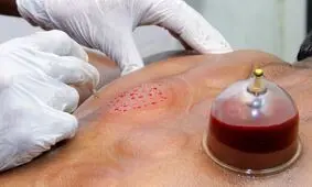 حجامت نمی‌تواند جایگزین واکسن کرونا شود