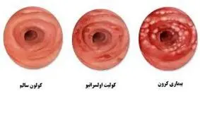 چه کسانی بیشتر در معرض ابتلا به بیماری التهابی روده هستند؟