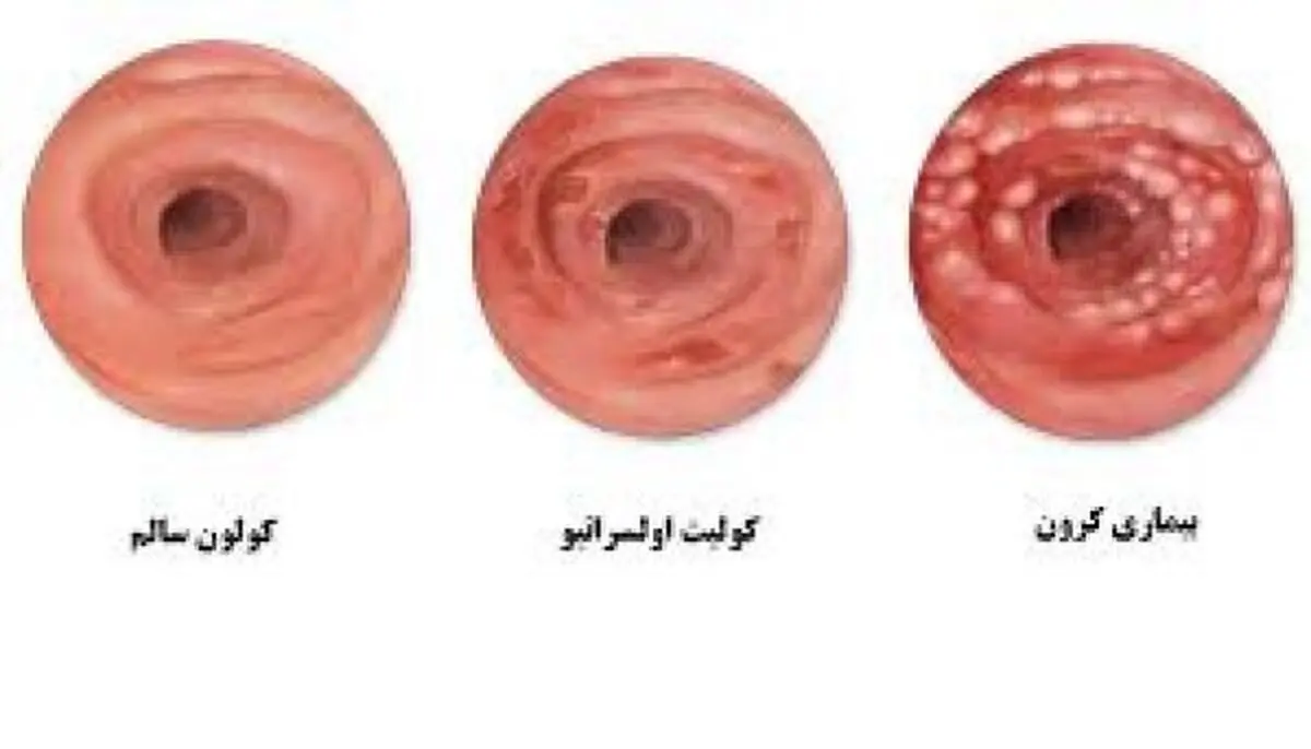 چه کسانی بیشتر در معرض ابتلا به بیماری التهابی روده هستند؟