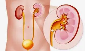 درمان سنگ کلیه با رژیم غذایی
