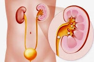 درمان سنگ کلیه با رژیم غذایی