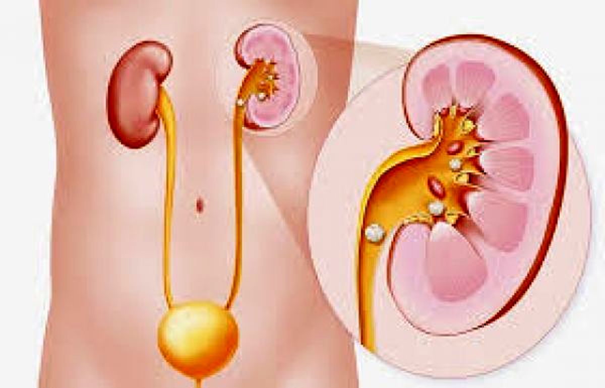 درمان سنگ کلیه با رژیم غذایی