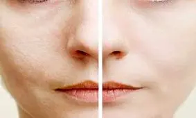 5 عادت غذایی که پوست را خراب می‌کند