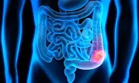 پیشگیری و درمان سرطان روده با ماست و شیر