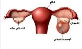 استرس، شایع‌ترین علت بروز کیست در زنان/ مبتلایان به کیست‌های تخمدانی شنا نکنند