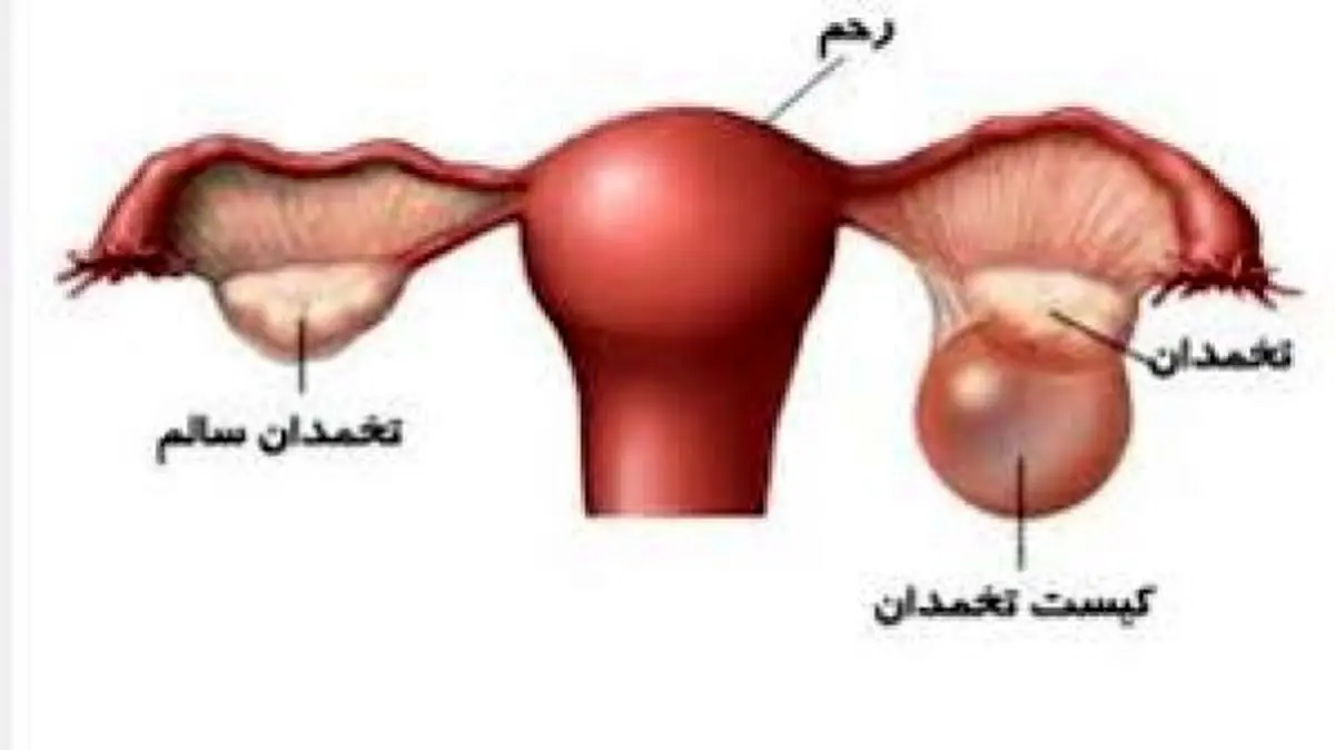 استرس، شایع‌ترین علت بروز کیست در زنان/ مبتلایان به کیست‌های تخمدانی شنا نکنند