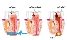تهدید سلامت قلب با تاخیر در درمان دندان‌های پوسیده