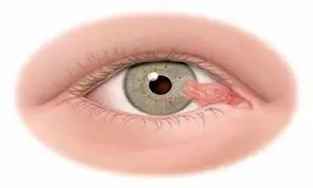 مهم‌ترین عوامل موثر در بروز عارضه «ناخنک چشم»