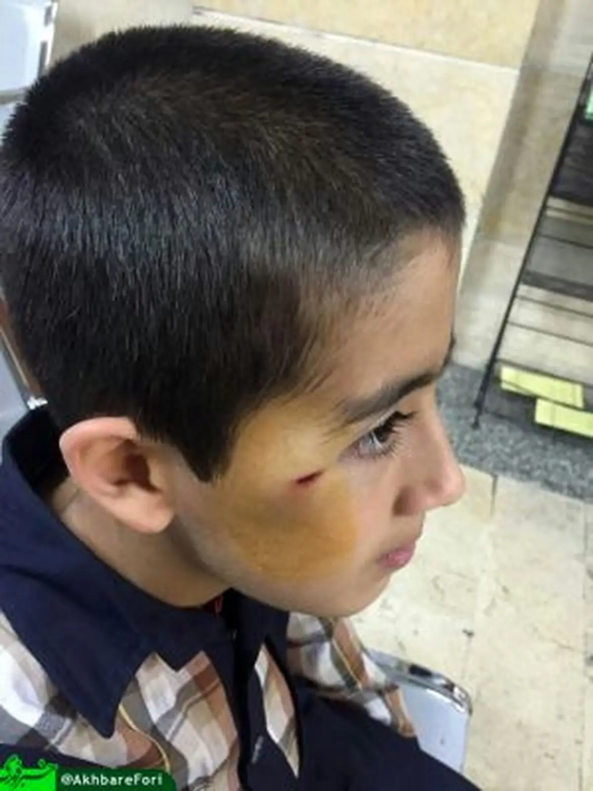 جراحت یک دانش آموز بر اثر تنبیه بدنی