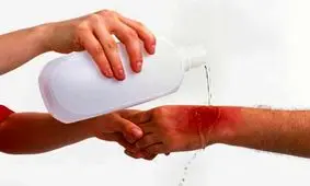 اشتباهات رایج در درمان سوختگی