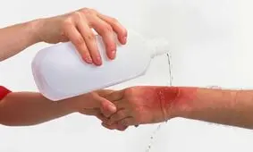 اشتباهات رایج در درمان سوختگی