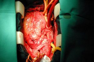 جراحی قلب در بعدازظهر عوارض کمتری دارد